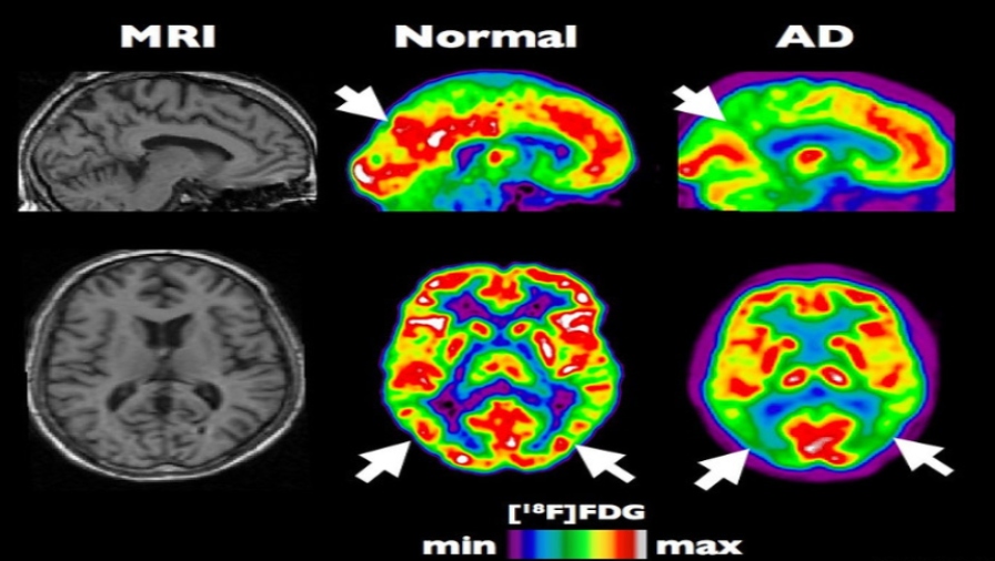 Images of brains with and without Alzheimer's Disease, with MRI on the left and PET the middle and right scans. Photo: Institut Douglas